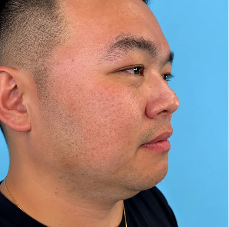 Lower face, Before