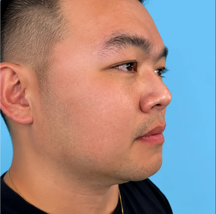 Lower face, After