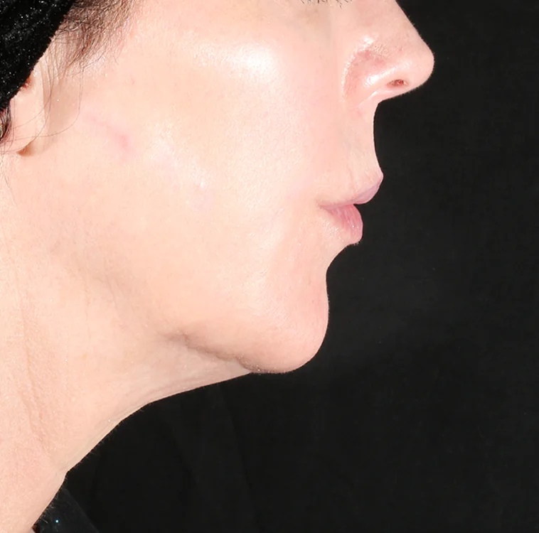 Under the chin, After