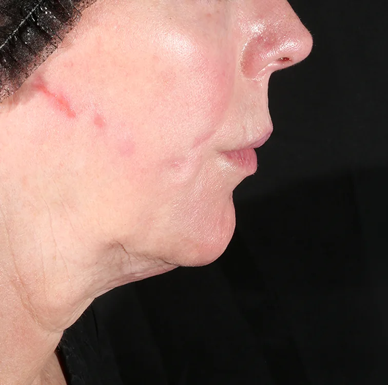Under the chin, Before
