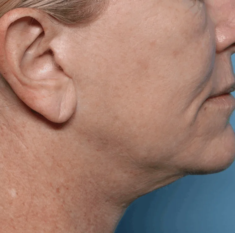 Jawline, Before