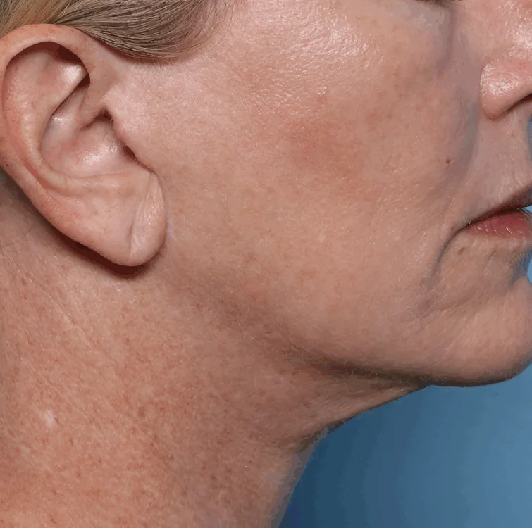 Jawline, After