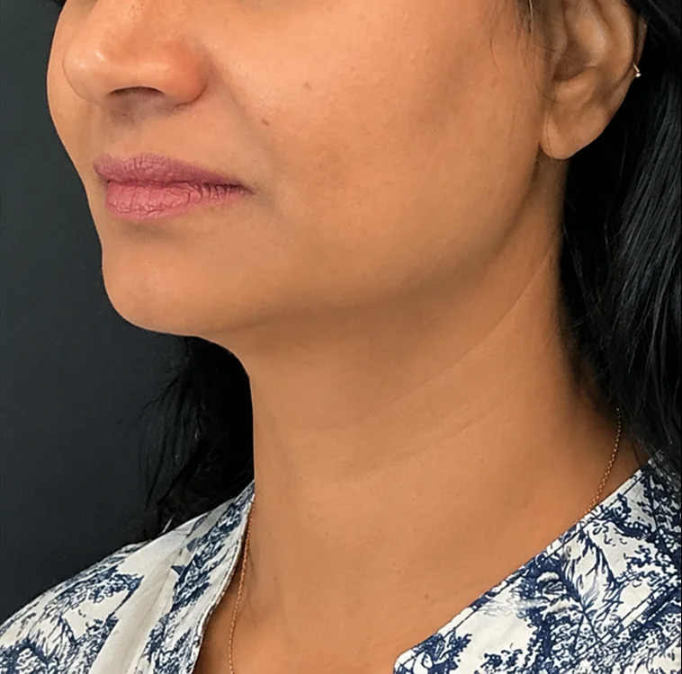 Neck, After